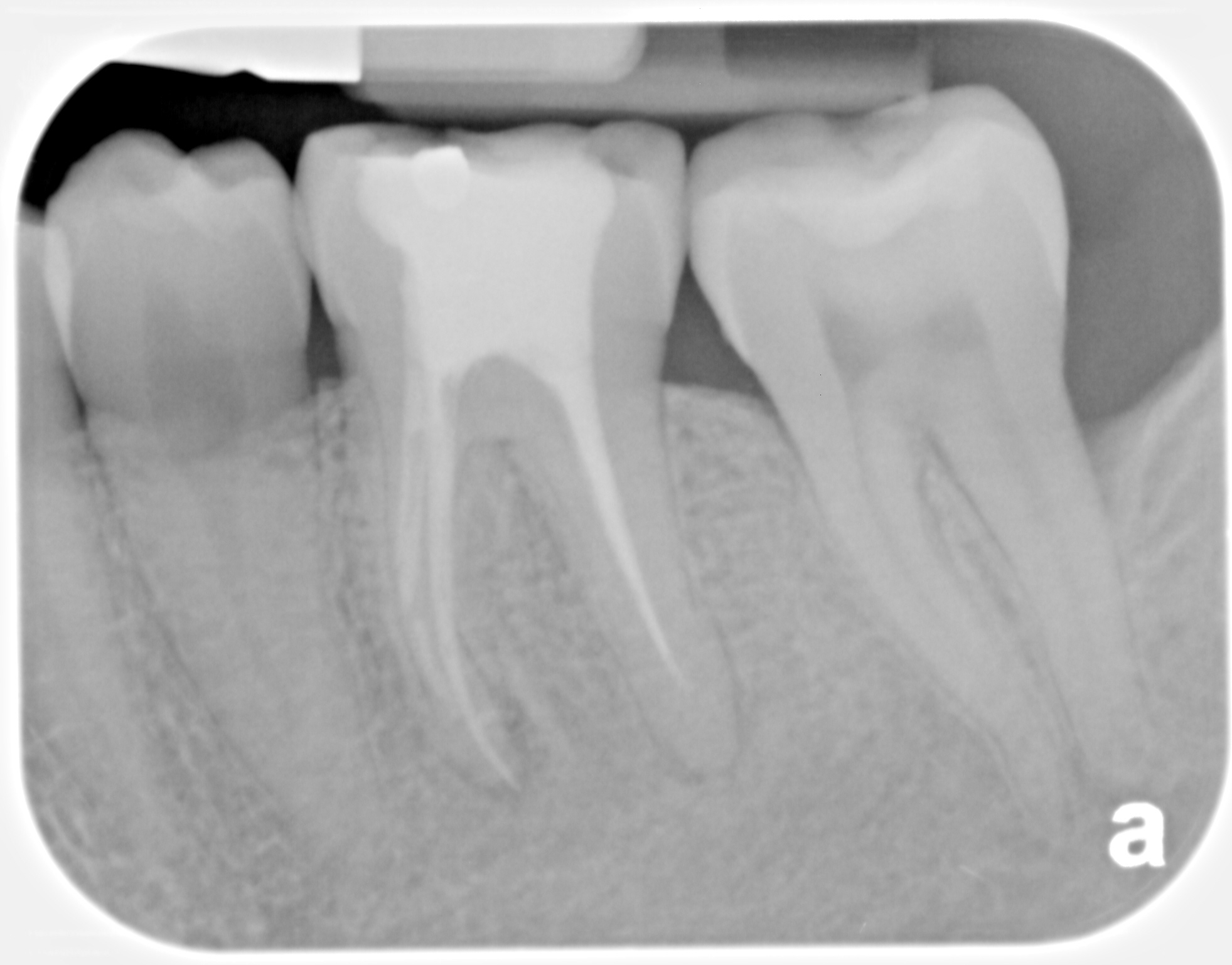 Bone regrowing between roots after LANAP, Laser and cosmetic dentistry in Louisville